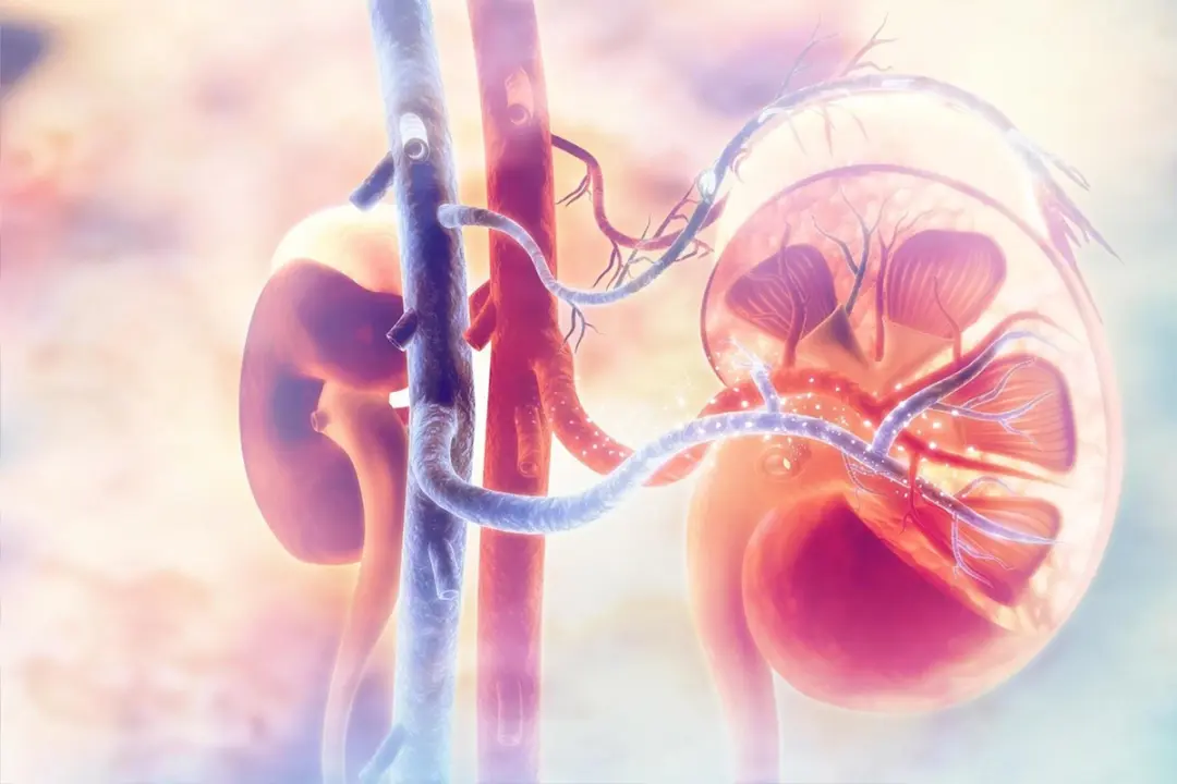 Millions of Chronic Kidney Disease Cases Remain Undiagnosed, Study Finds