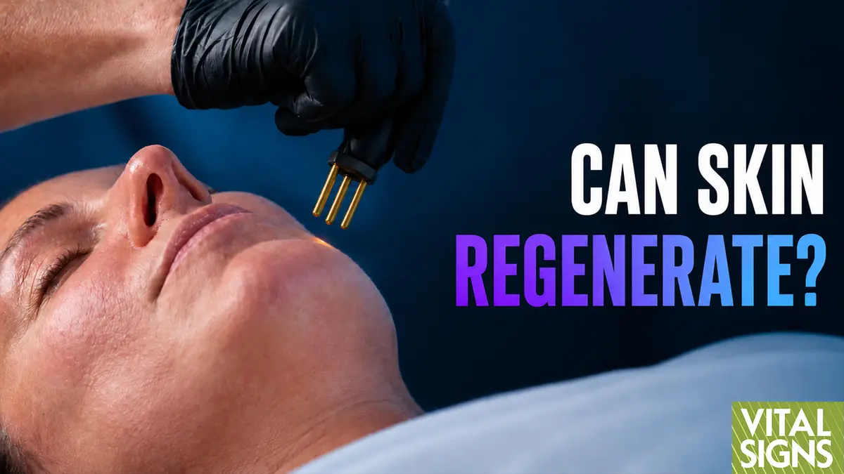 Nitrogen Plasma: Skin Treatment Hope for Acne Scars, Wrinkles, Sagging? thumbnail