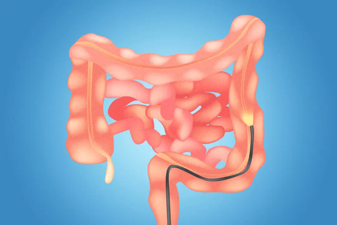 Single Sigmoidoscopy Cuts Colorectal Cancer Risk for More Than 20 Years