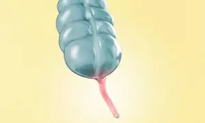 Removing the Appendix Linked to Higher Alzheimer’s Risks