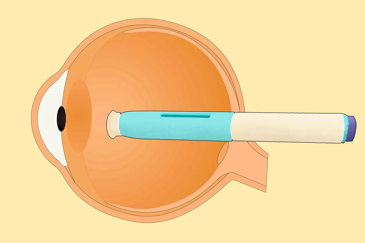 Migraine Drugs May Cut Glaucoma Risk by 25 Percent