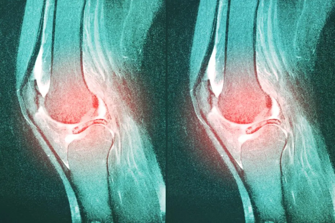 One of the Most Common Knee Surgeries May Be Doing More Harm Than Good