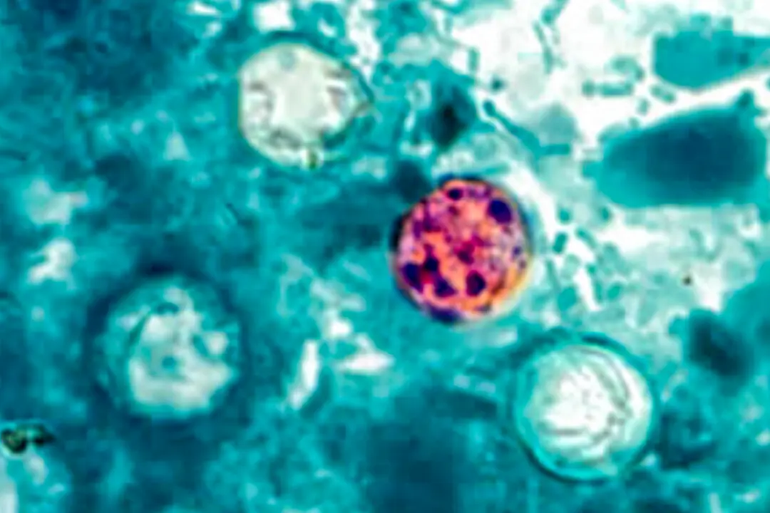 More Than 15,000 Cases of Parasite That Causes Diarrhea in US: CDC