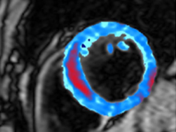<a><img src="https://www.theepochtimes.com/assets/uploads/2015/09/BleedingHeart.jpg" alt="The coloured area on this MRI scan shows a cross-section of the heart muscle, with the area of bleeding shown in red. (Imperial College London)" title="The coloured area on this MRI scan shows a cross-section of the heart muscle, with the area of bleeding shown in red. (Imperial College London)" width="320" class="size-medium wp-image-1831119"/></a>