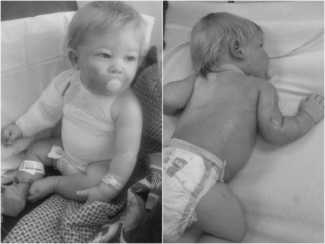 The dark area on the right side of child's back are burns he suffered (Screenshot/Changed to black and white by The Epoch Times)