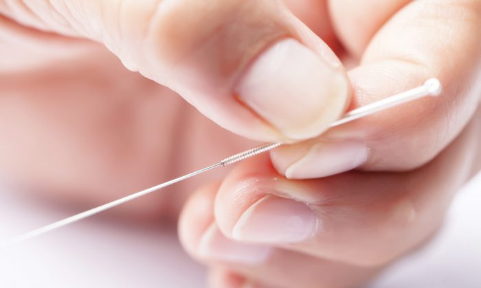 acupuncture-lowers-high-cholesterol-acupuncture-the-epoch-times