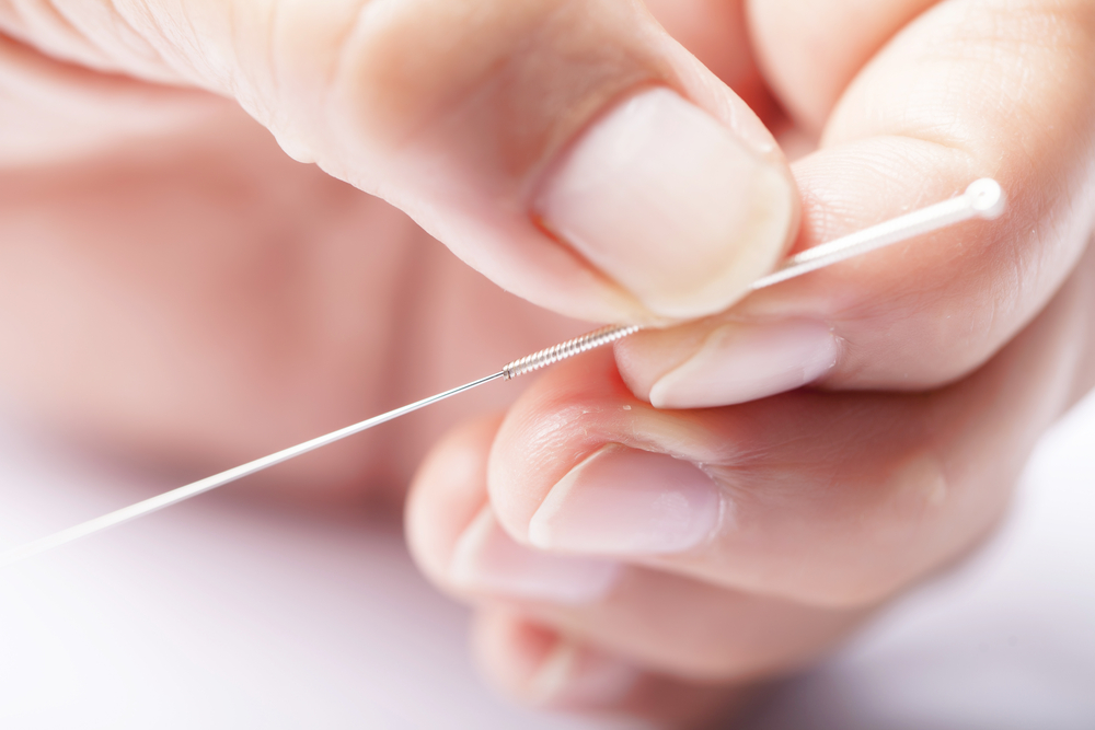 acupuncture-lowers-high-cholesterol-acupuncture-the-epoch-times