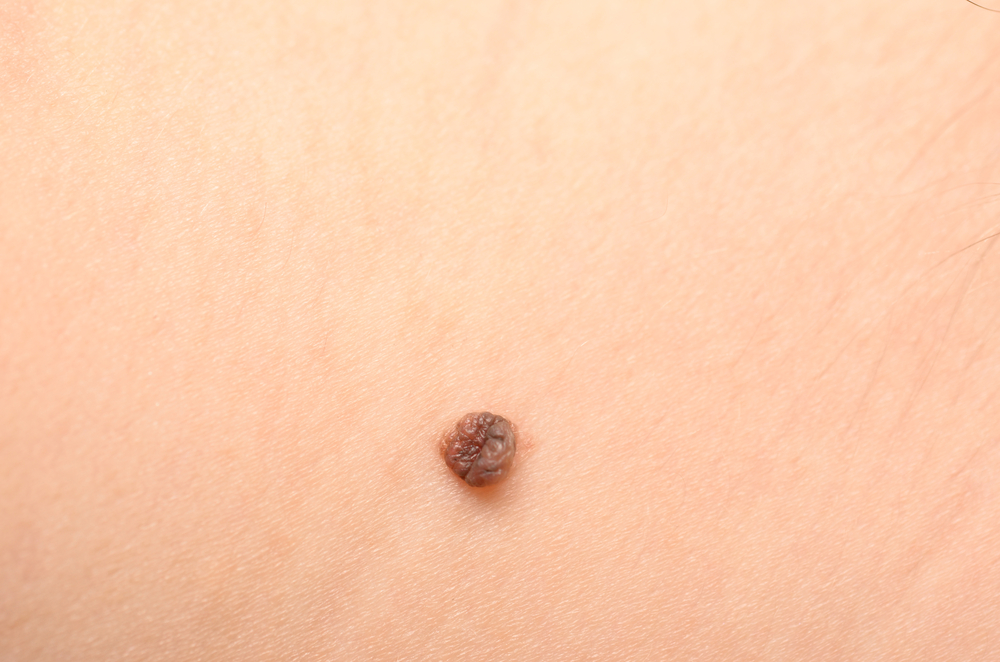 the-abcde-test-to-identify-the-most-dangerous-form-of-skin-cancer