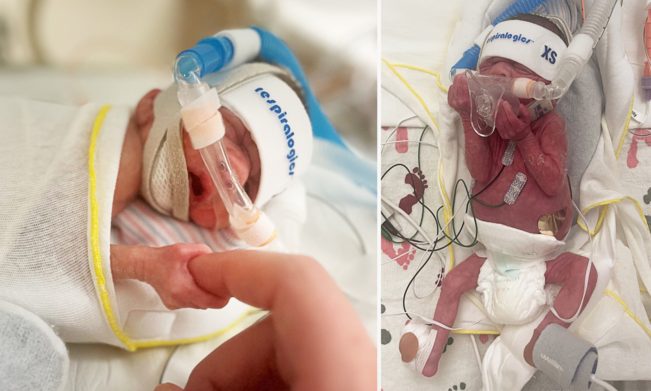 Tiny Baby Who Could Fit in Mom’s Hand Is Back Home, Thriving and Smiling After 181 Days in NICU