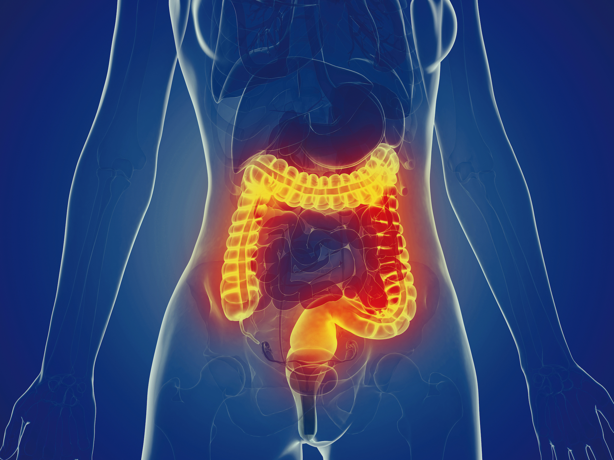 Major Cause of Diverticulitis