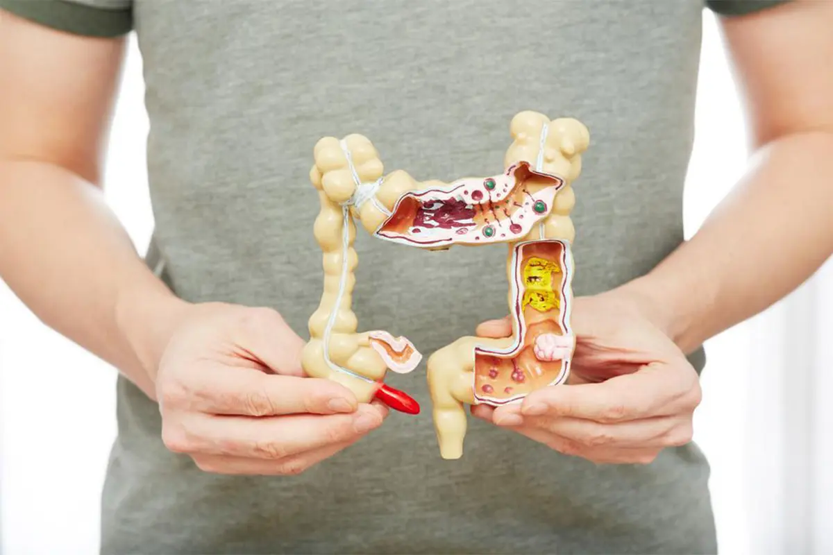 Nearly 45 Percent of Colorectal Cancers in US Occur Among People Under 65, Study Warns