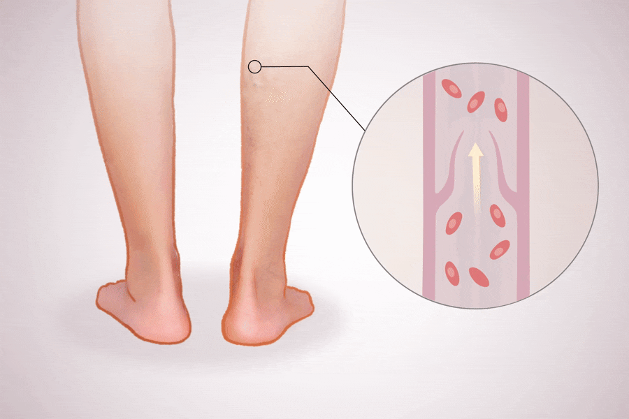 Deep Vein Thrombosis: A Silent Condition That Can Turn Serious–Beware of the Causes