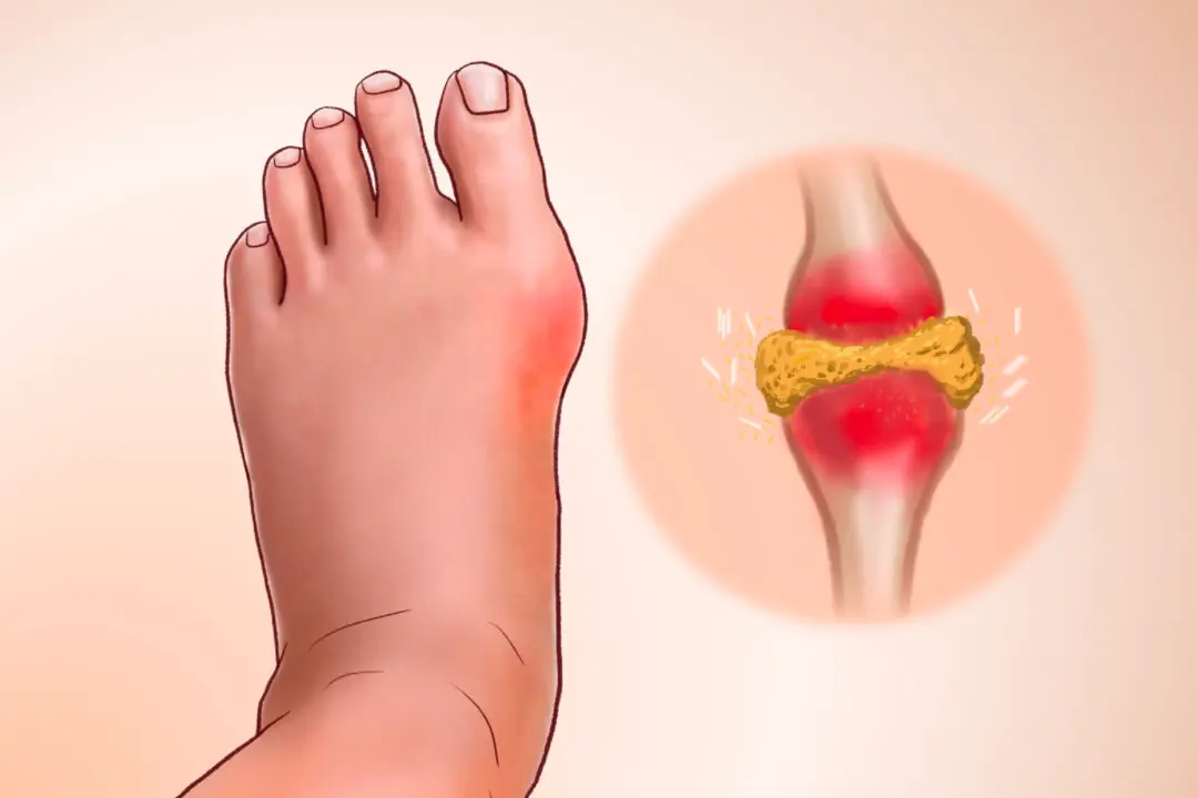 Gout: Crystallized Urate Accumulates in the Joint–6 Natural Approaches to Relieve It