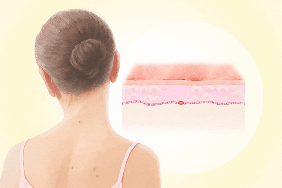 Melanoma: The Aggressive Skin Cancer That Can Spread Quickly–Here Are the Warning Signs