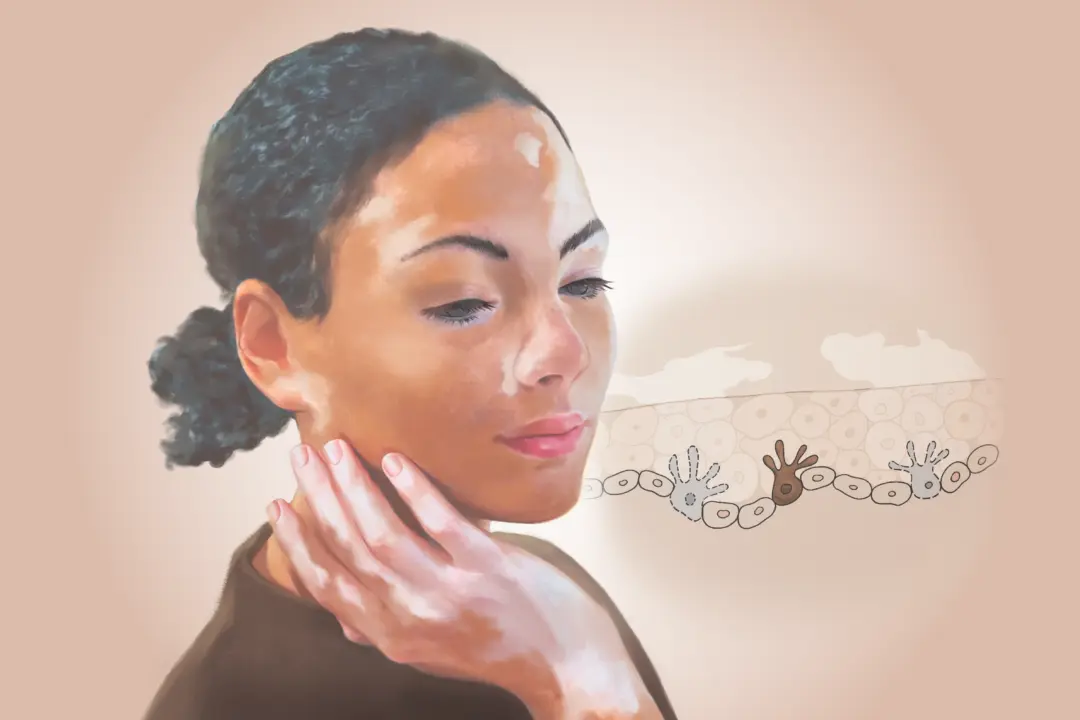 Vitiligo: The Autoimmune Condition That Turns Skin Against Itself—Here Are the Causes