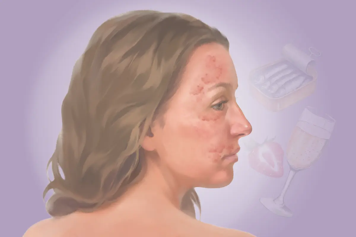 Histamine Intolerance: An Underrecognized Condition That Can Affect Multiple Organs–Here Are the Causes