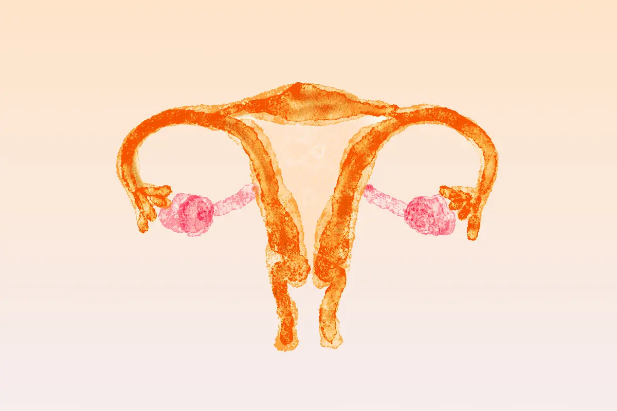 PCOS: One of Women’s Most Misunderstood Conditions