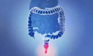 New Review Reveals Best Practices for Hemorrhoid Treatment