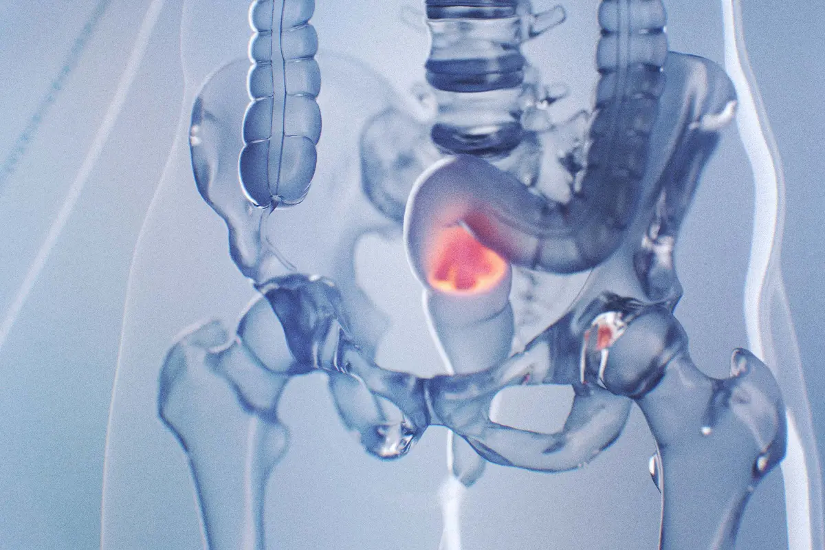 More Young Adults Are Dying From Rectal Cancer–Early Signs Often Go Unnoticed