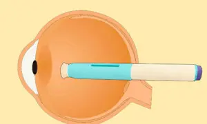Migraine Drugs May Cut Glaucoma Risk, New Study Finds