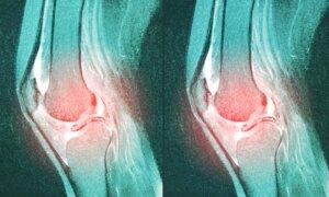 1 of the Most Common Knee Surgeries May Be Doing More Harm Than Good