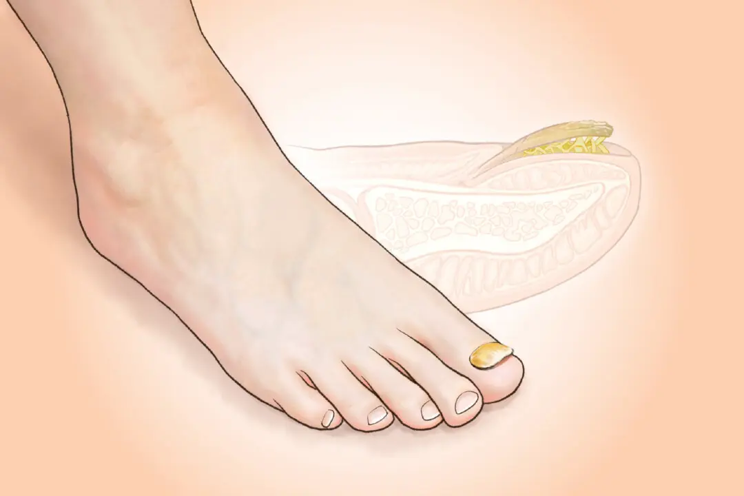 Toenail Fungus: A Stubborn Infection Affecting 1 in 10 People–Signs to Watch For
