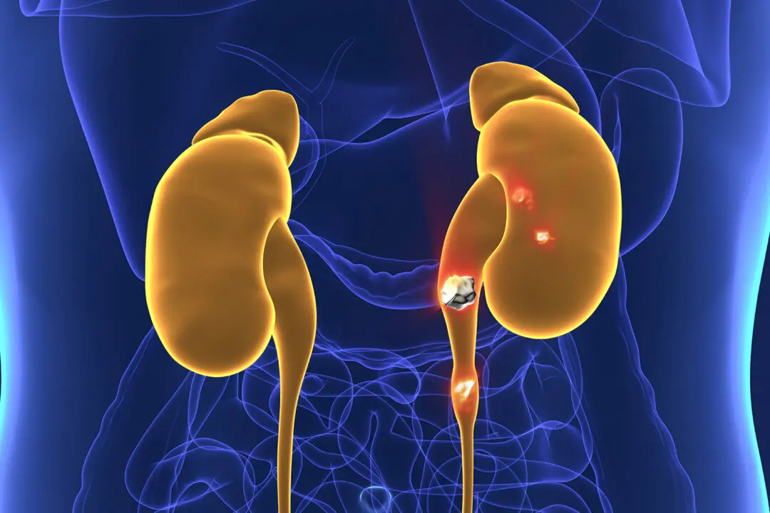 Kidney Stones May Actually Be Bacterial Colonies, Study Finds