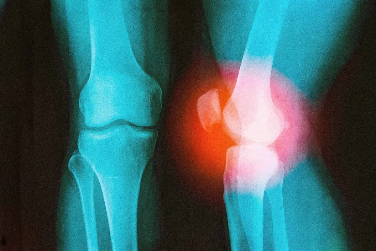 How a Surgeon With a Damaged Knee Learned to Outsmart Arthritis
