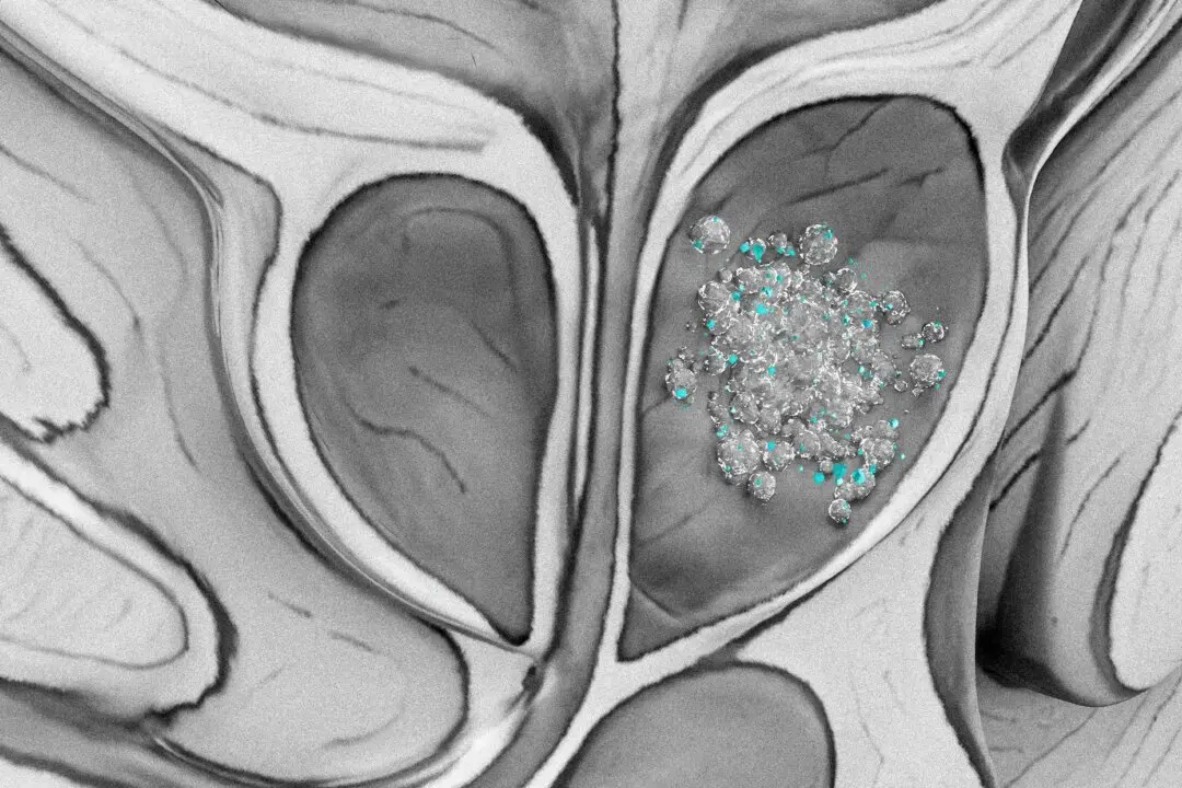 Microplastics Found in 9 of 10 Prostate Cancer Samples in Pilot Study