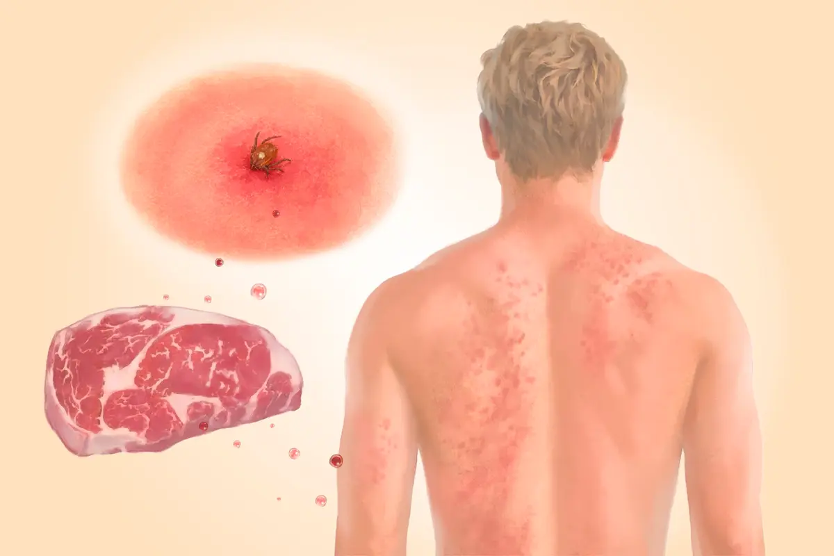 Alpha-Gal Syndrome: How a Tick Bite Triggers Sensitivity to Meat–Here Are the Causes