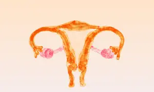 PCOS: One of the Most Misunderstood Conditions Women Face