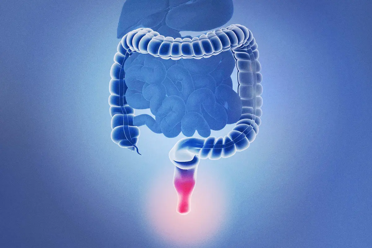 Hemorrhoids–Expert’s Review Offers Best Practice Advice