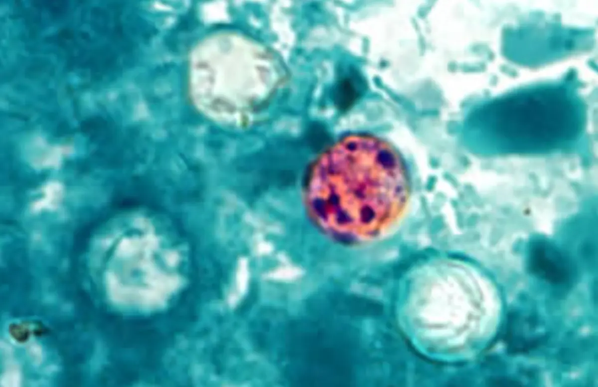 Largest Cyclosporiasis Outbreak in US Expands to 9 States: CDC